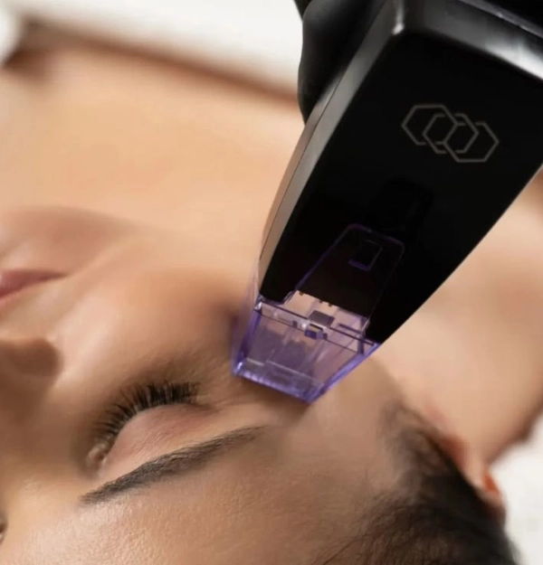 Morpheus8 treatment at prolase
