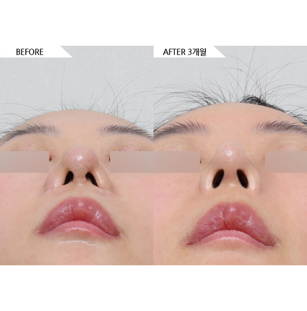 Before and after results of revision rhinoplasty including nose bridge augmentation, tip refinement, bulbous nose correction, functional nose surgery, and scar tissue removal in Korea