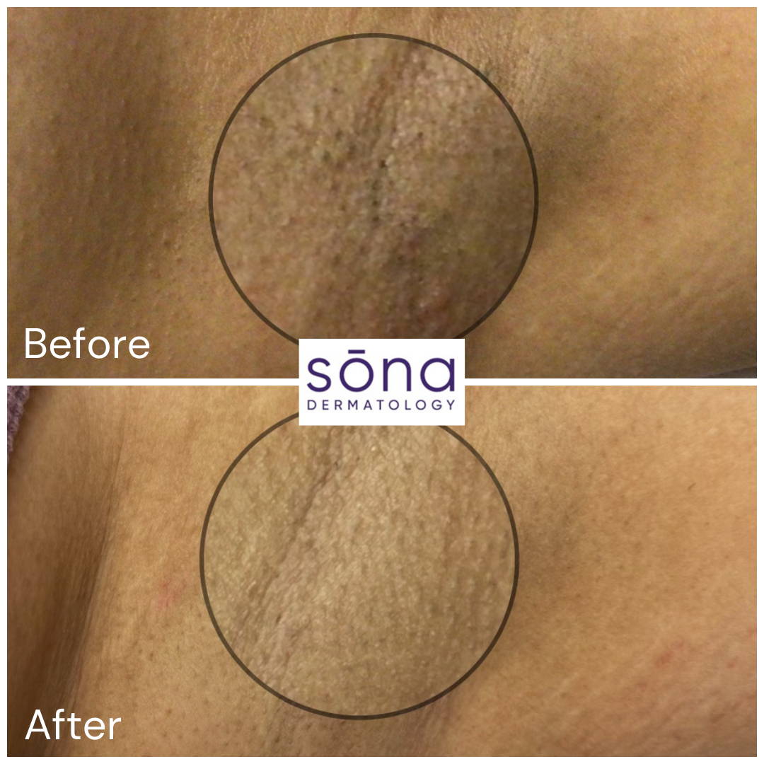 Sona Motus AY Laser Hair Removal Before & After 1