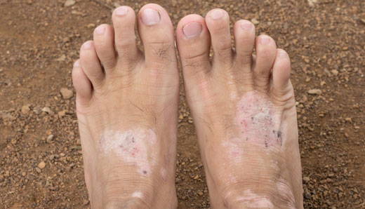 A picture of feet with white patches