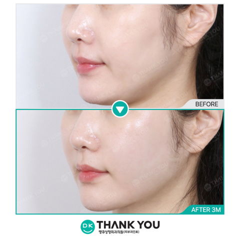 Before and After 3 Months of Thermage Treatment and RF Skin Tightening at Thank You Plastic Surgery in Korea