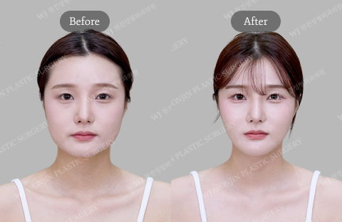 Face Lift Using Threads and Jawline Thread Lift with Face Contouring and Fat Grafting – Before and After in Korea by Jivaka Beauty