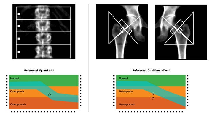 Get screened for osteoporosis using DEXA scans