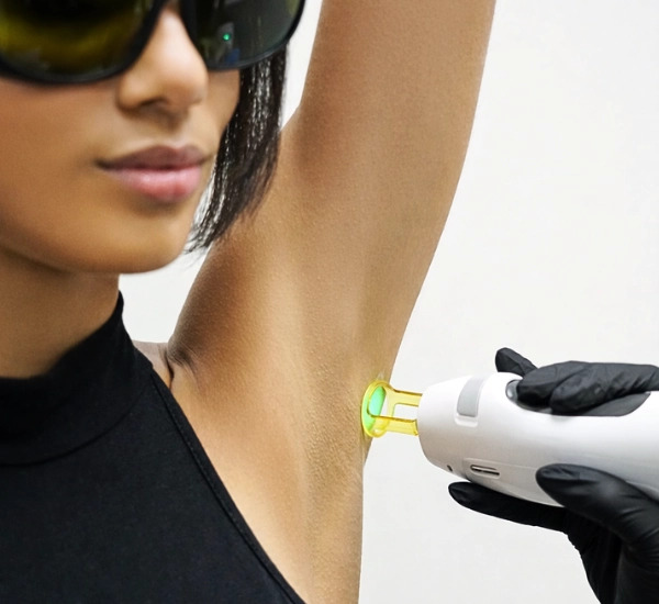Client getting laser hair removal on underarm at prolase clinic.