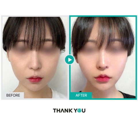 Before and After InMode RF Skin Tightening at Thank You Plastic Surgery in Korea Through Jivaka Beauty