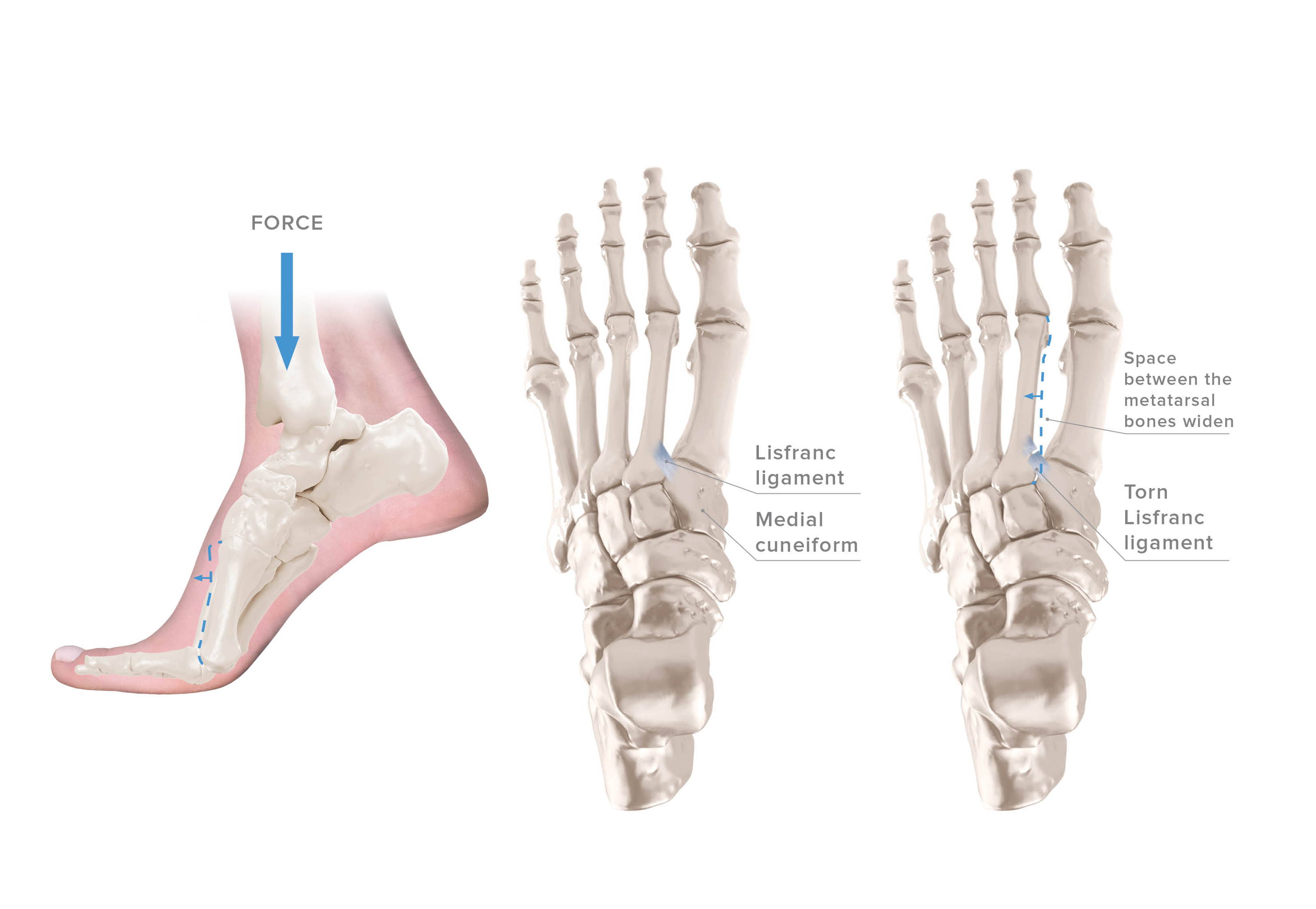 Lisfranc Injuries