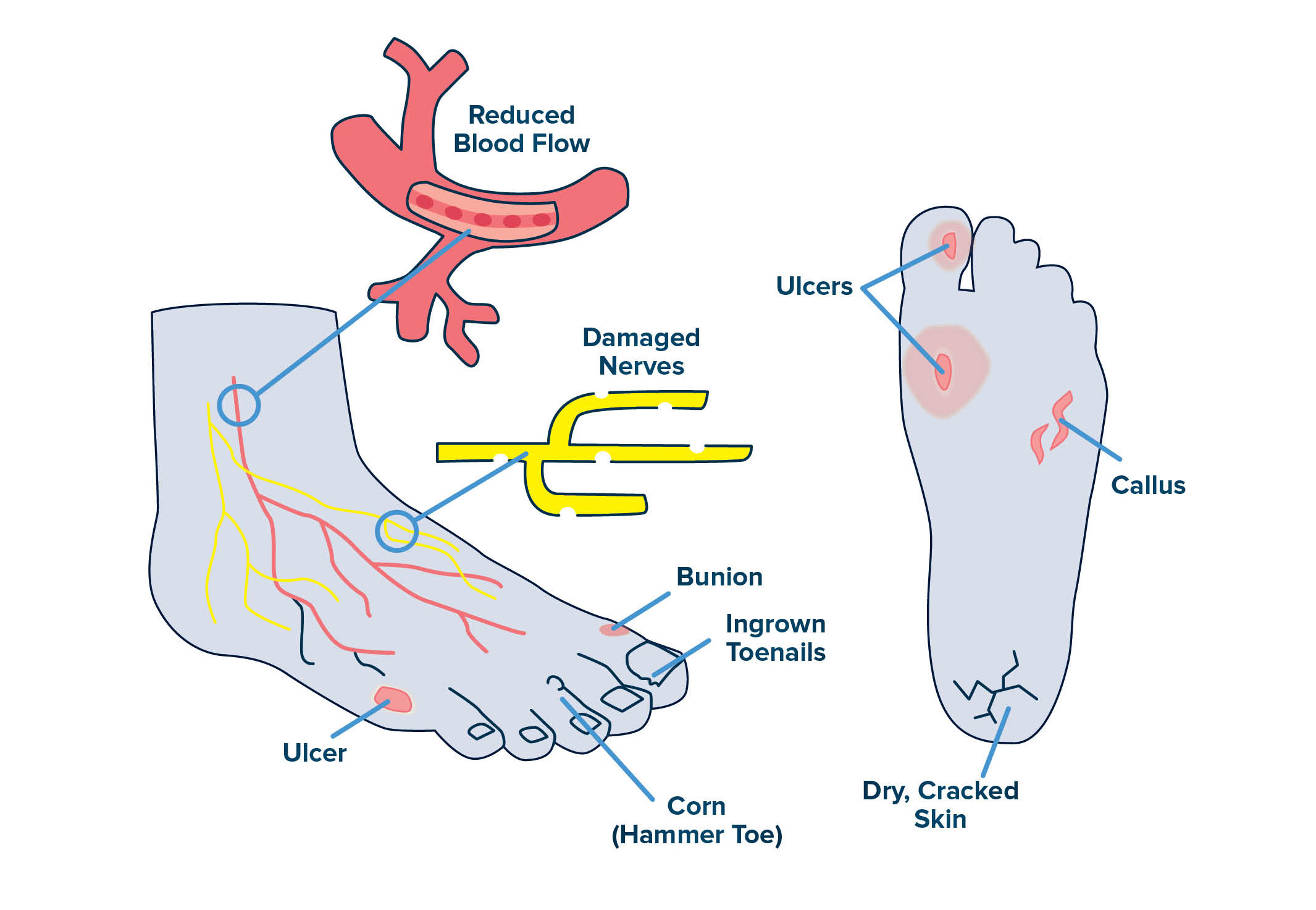 Diabetes Complications and Amputation Prevention