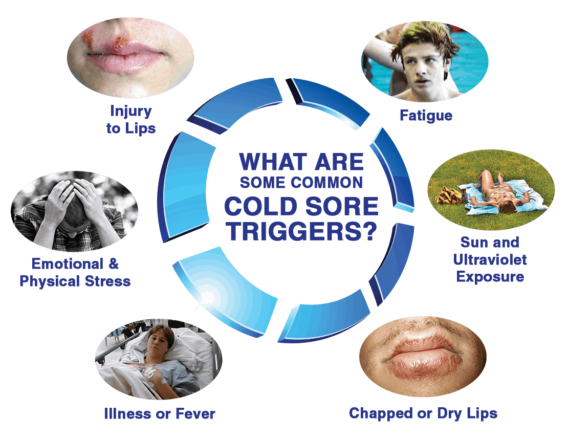 Cold sores infographic