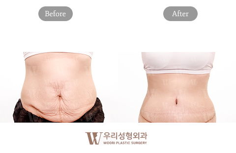 Mommy Makeover Korea Tummy Tuck Before and After Results at Woori Plastic Surgery Clinic