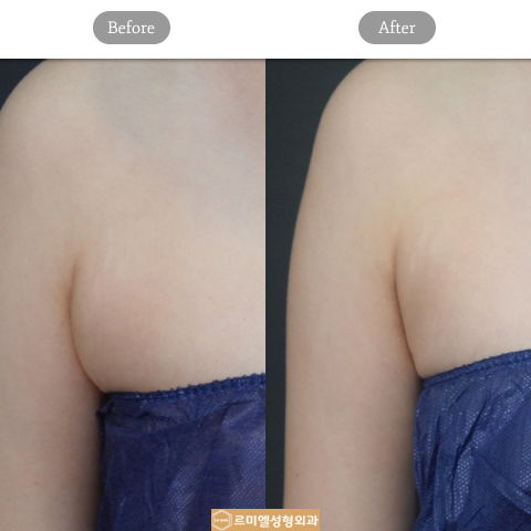 CoolSculpting Before And After Results For Arm Fat Reduction Using Noninvasive Liposuction In Korea