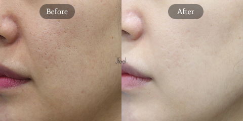 Results of Korean Summer Skin Treatments for Acne Scars, Enlarged Pores, and Pigmentation with Potenza RF Microneedling and Pico Toning Korea