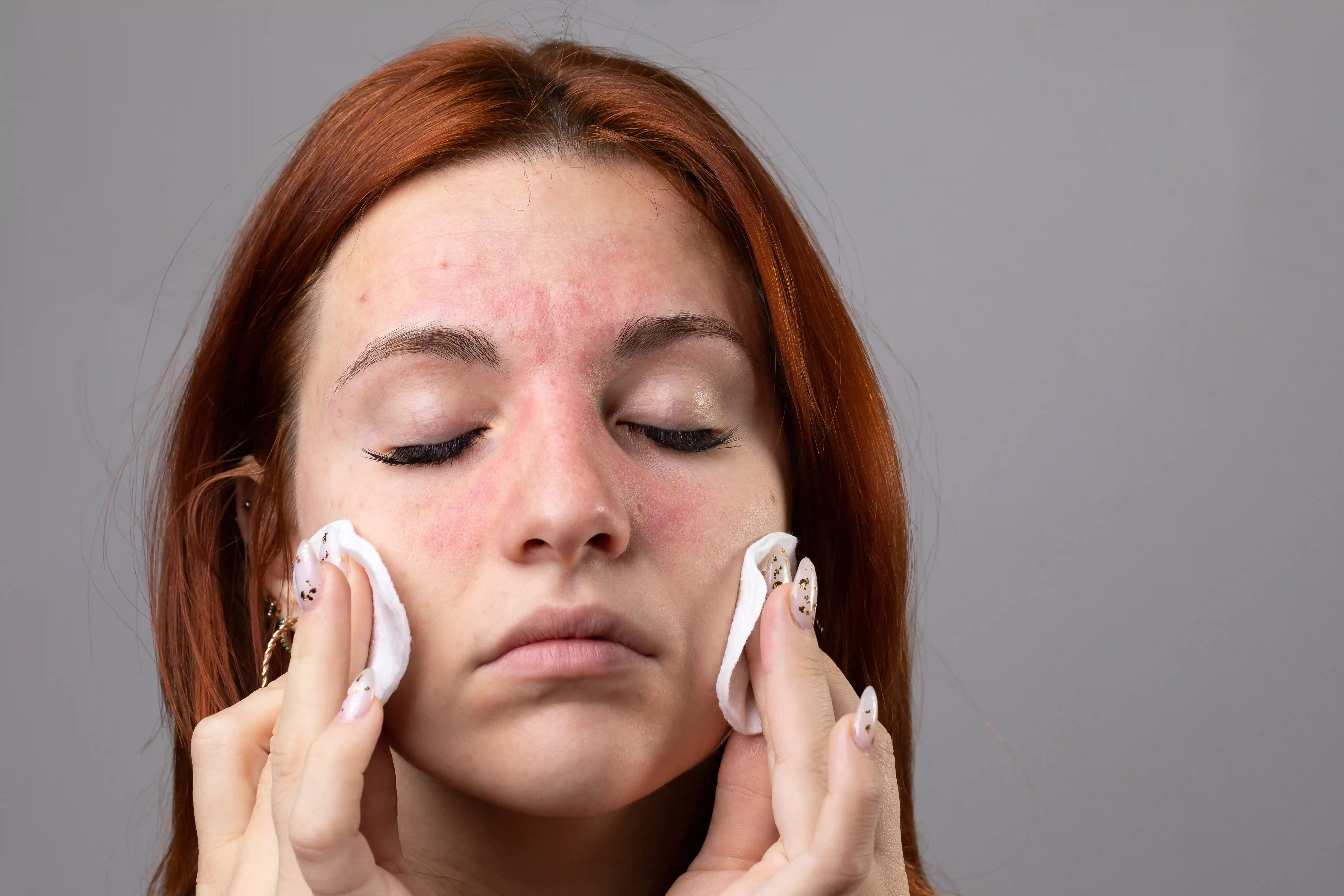 Close-up van een vrouw die wattenschijfjes op haar gezicht aanbrengt, waarbij een rode, geïrriteerde huid zichtbaar is als gevolg van een allergische reactie (contactallergie).