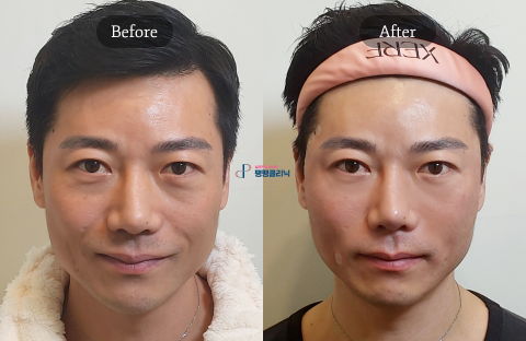 Male Plastic Surgery in Korea Featuring Deep Plane Facelift for Natural Facial Rejuvenation and Jawline Definition