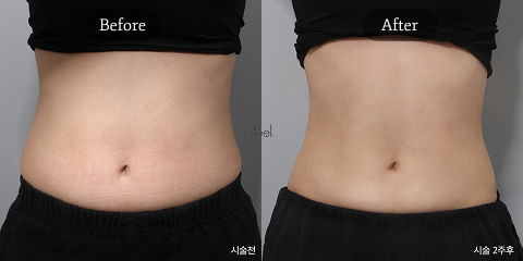 Non-Surgical Body Contouring in Korea with EMSculpt for Skinny Fat Treatment and Muscle Definition After Weight Loss