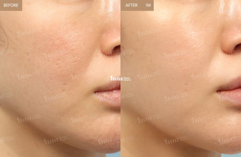 1 month results of Juvelook skin booster showing skin texture improvement as a Korean filler alternative with Rejuran Healer