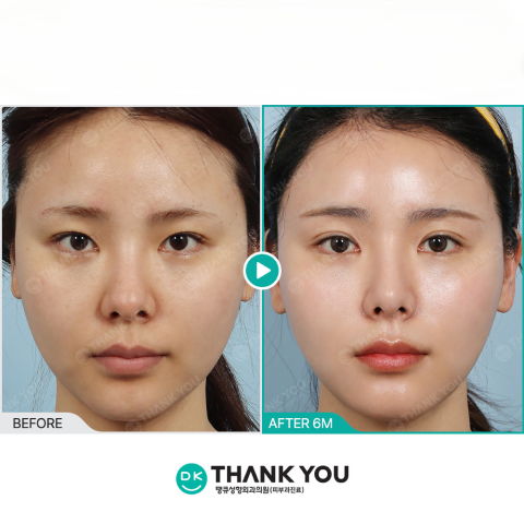 6 months results of Juvelook and Rejuran Healer skin lifting treatment as a Korean filler alternative for long-lasting collagen regeneration