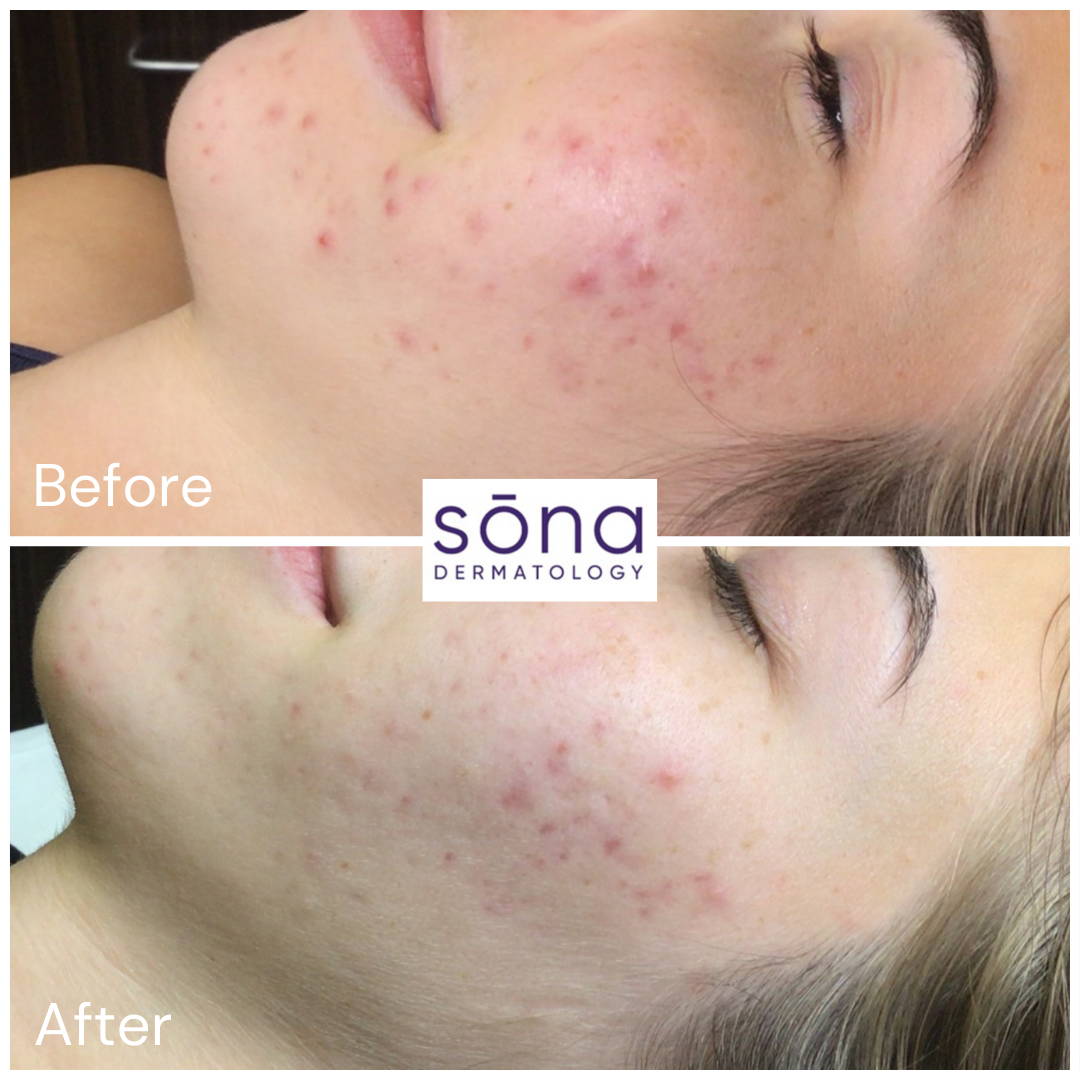 Sona DiamondGlow Facial Before & After 3