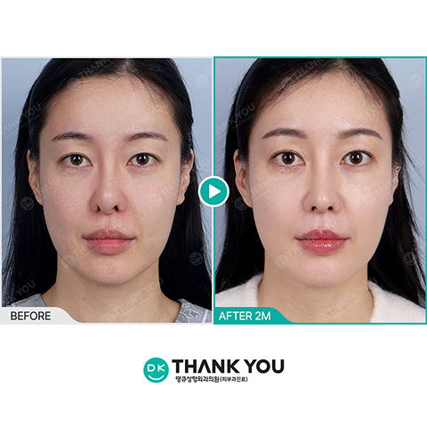 Glass Skin Improvement After Rejuran PDRN Injection as a Korean Skin Booster Treatment in Seoul Dermatology Clinics