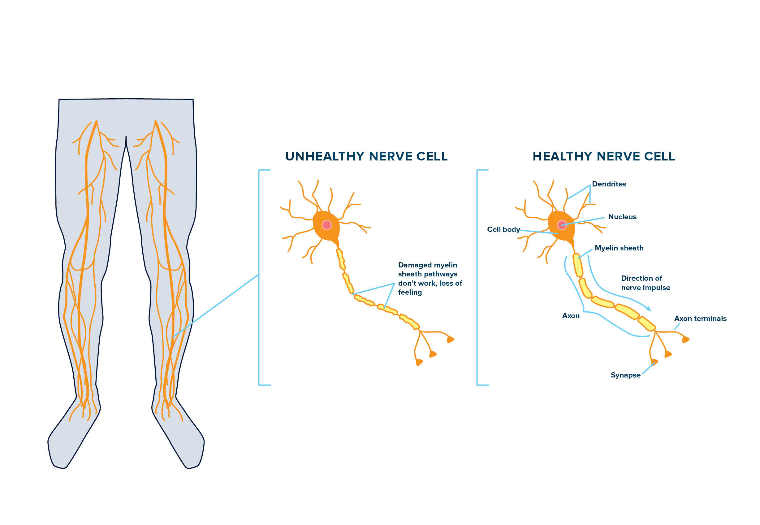 Ankle & Foot Related Neuropathy