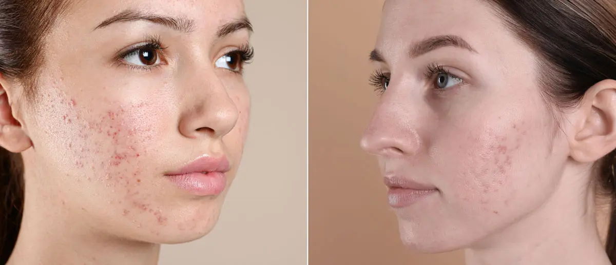 Two women with acne on their faces, side profile views - teenage vs adult acne