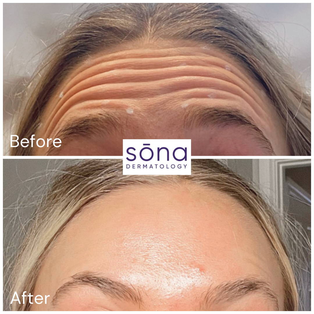 Sona - Botox Cosmetic Before & After 18