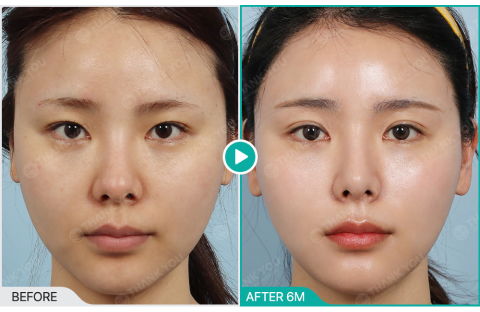 Before And After Review Image Of Rejuran Treatment At Thank You Plastic Surgery Clinic