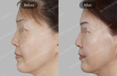 Before and After Premium Laser Toning Laser Treatment for Face at Wonjin Plastic Surgery in Korea