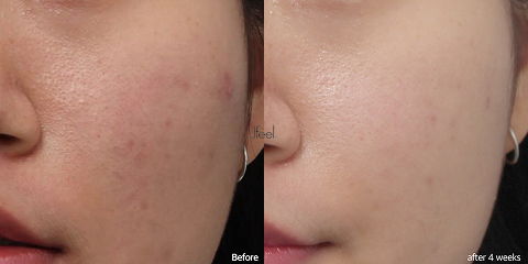Clinical Korean acne treatments using laser and aquapeel improving breakouts after personalized face and skin care analysis