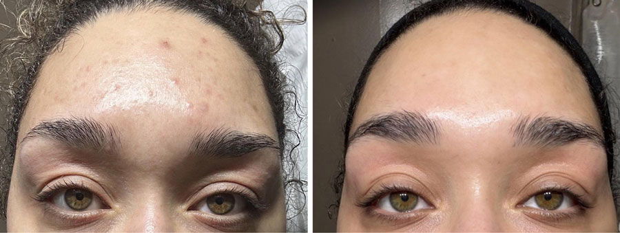 Comparison of two faces showing different skin conditions on foreheads.