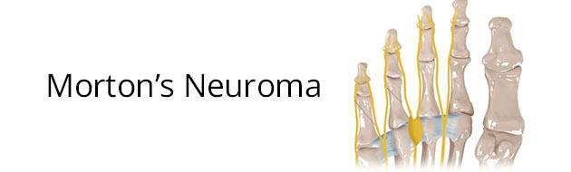 Morton’s Neuroma or Intermetatarsal Neuroma