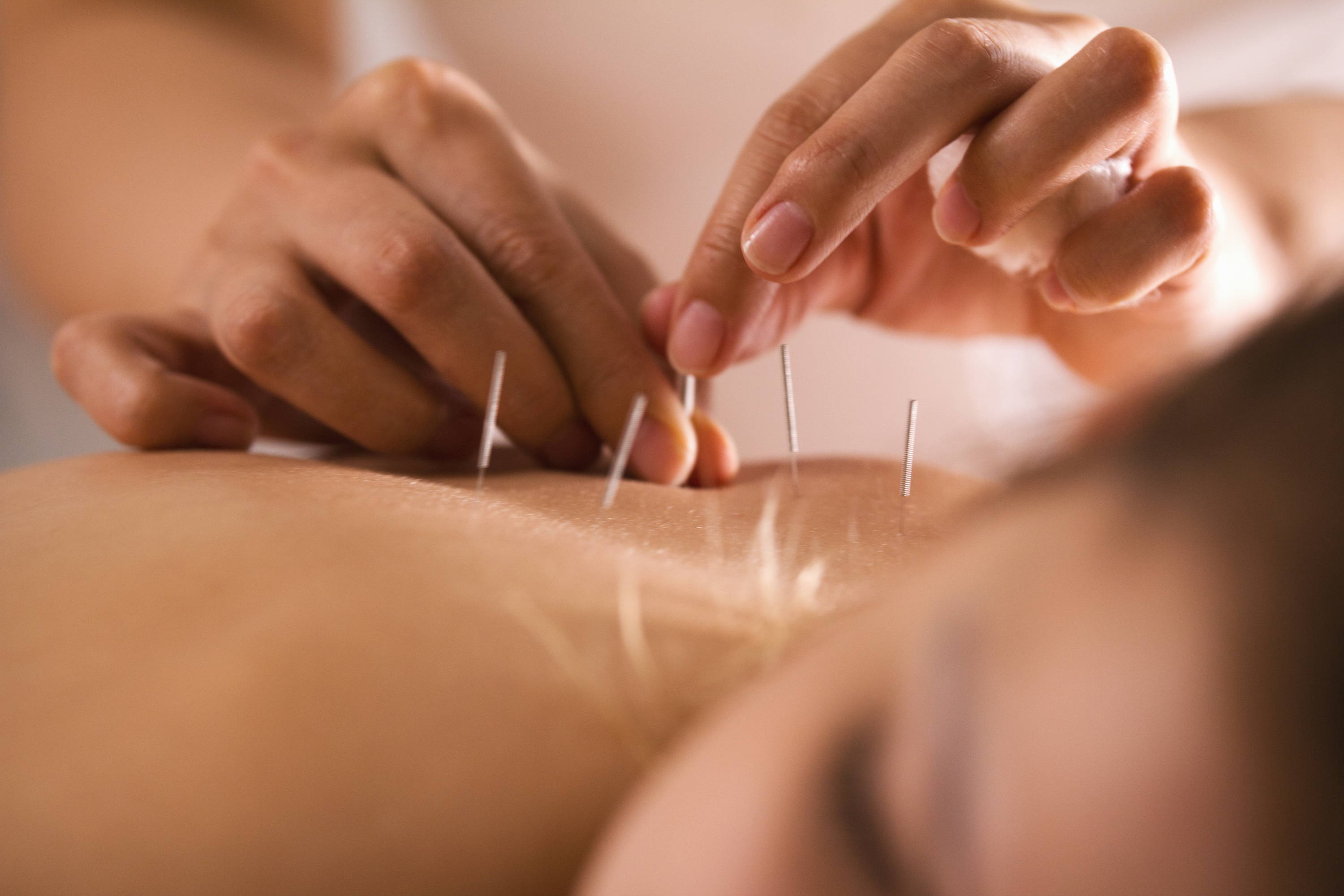 The doctor sticks needles into girl's body for acupuncture|applied kinesilogy and acupuncture |restore balance in your body